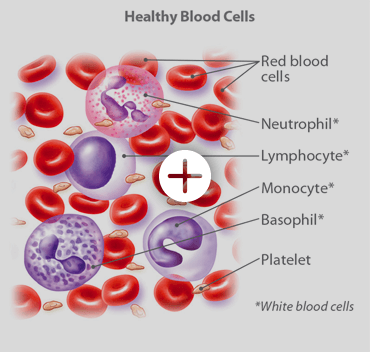 Blood cancers - types and treatment options | CTCA